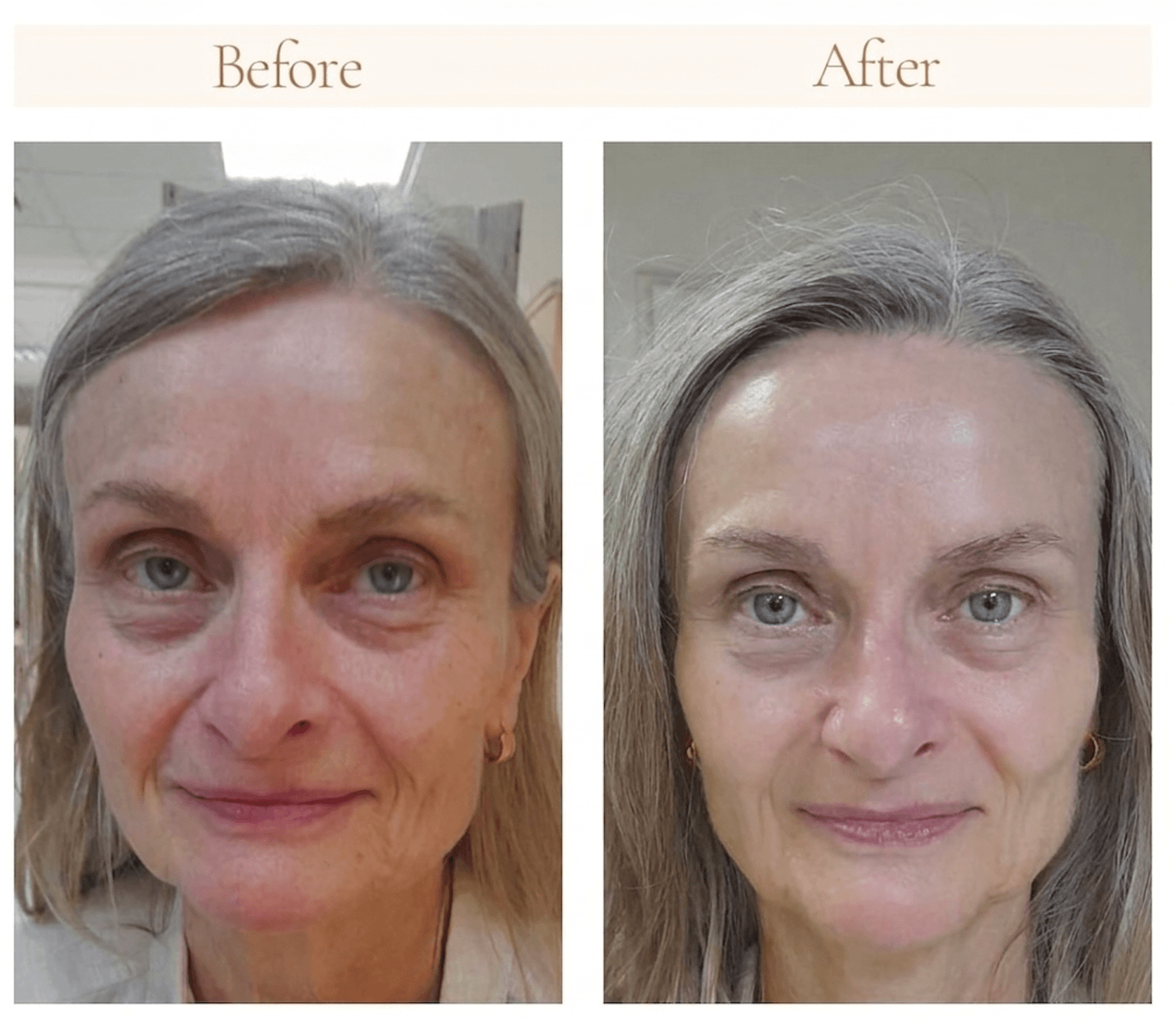Before-and-after portraits showing the face before and after a Hydraderm Lifting Signature Facial.